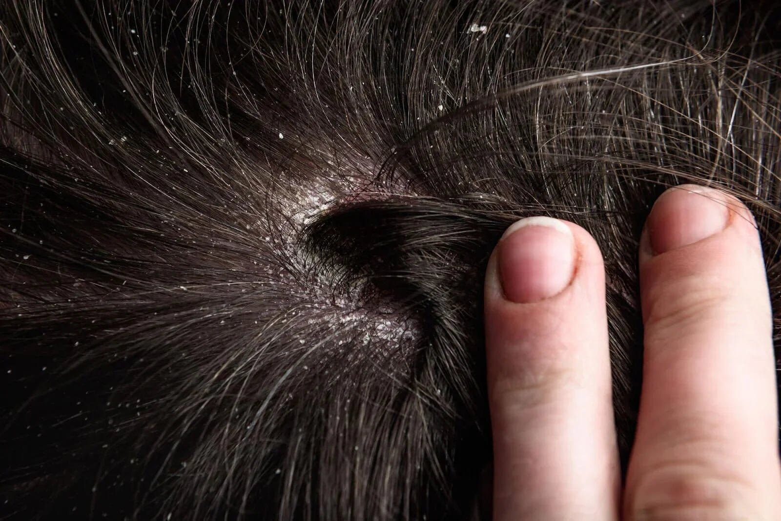 Best Dry Scalp Treatments in Singapore (2025 Dermatologist-Approved) - TwoHerbs