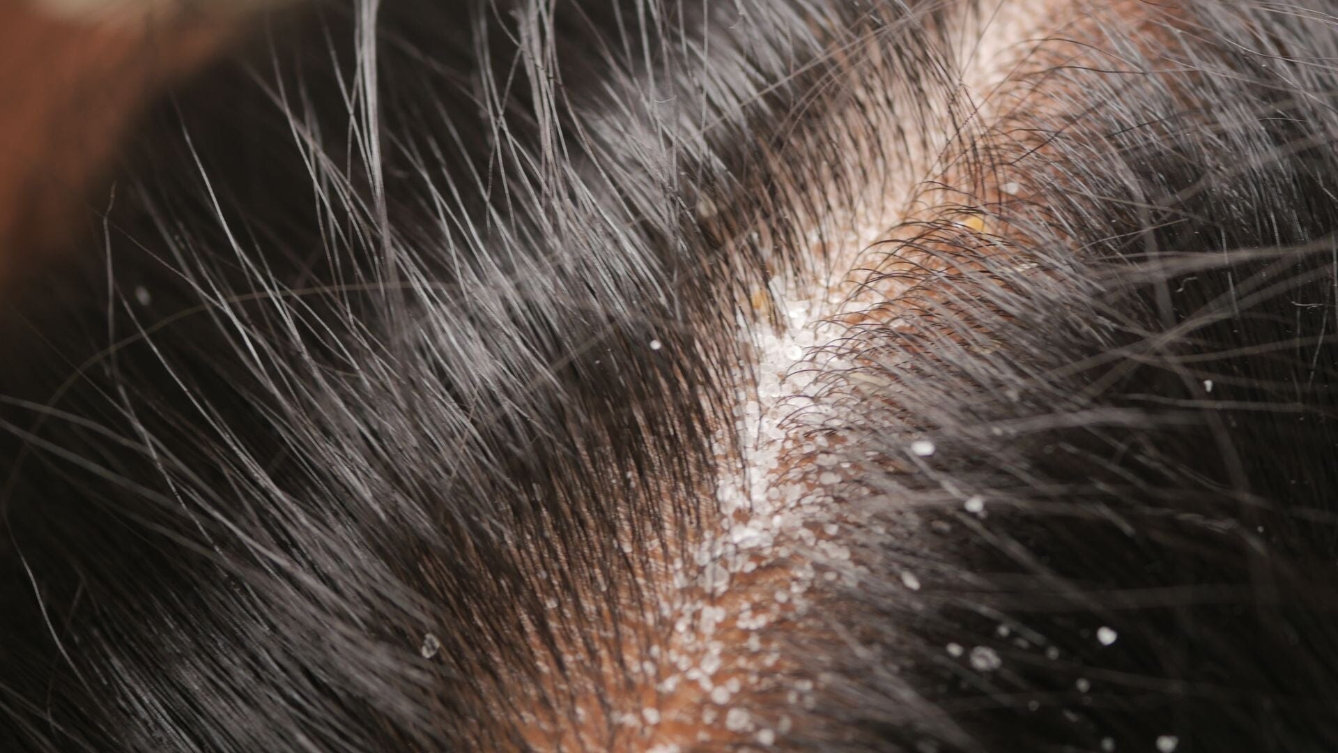 Best Hair Scalp Treatments in Singapore: 2026 Guide to Treat Scalp Problems + Best Solutions - TwoHerbs