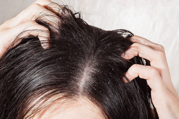 Dandruff Vs Dry Scalp: What's The Difference? - TwoHerbs