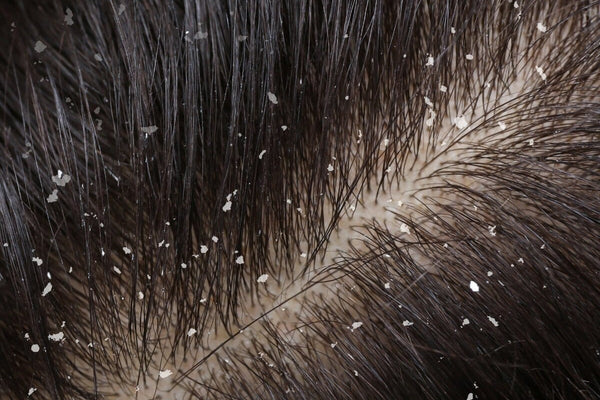 Does Dandruff Cause Hair Loss? Why Your Hair Falls Out With Flakes (And If It Grows Back) - TwoHerbs