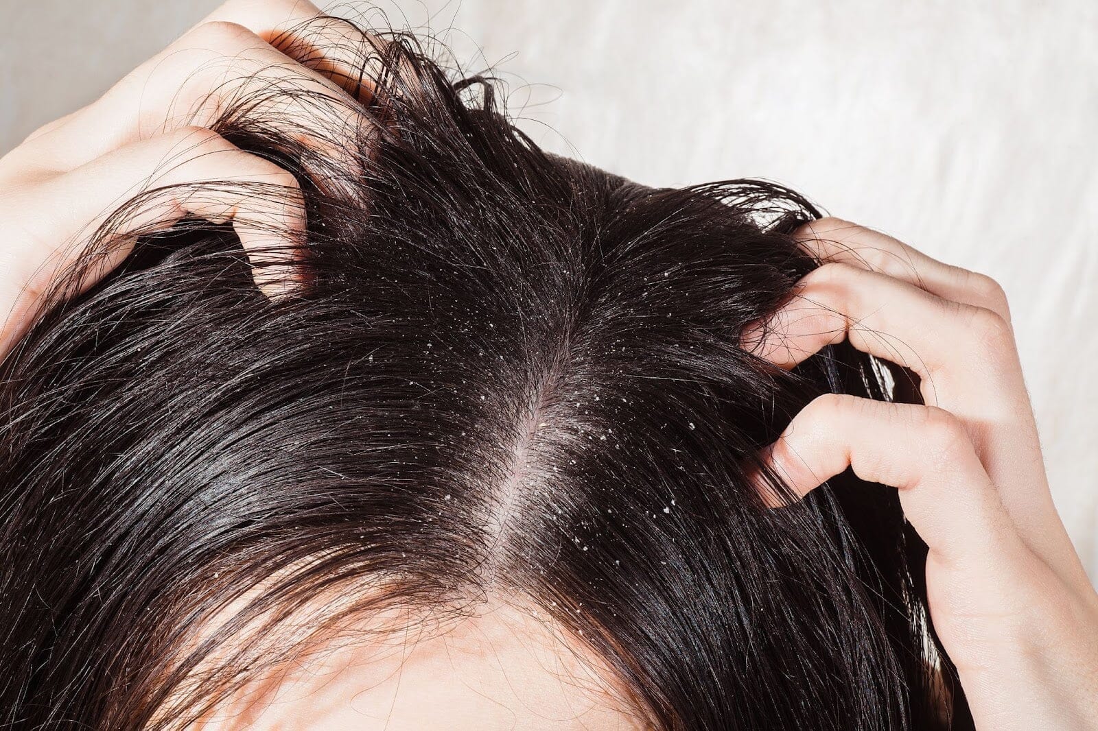 Dry Scalp Treatment Singapore | Causes, Best Solutions & Products - TwoHerbs