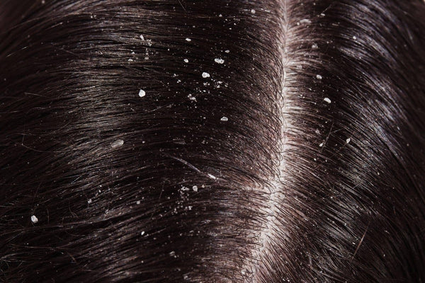 Dry Scalp Treatments in Singapore (2025): Causes, Remedies & Solutions - TwoHerbs