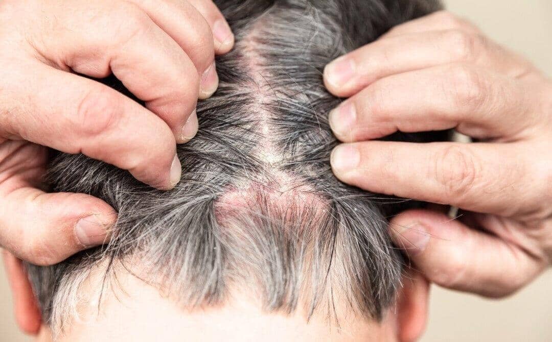 How to Treat and Manage Scalp Psoriasis - TwoHerbs