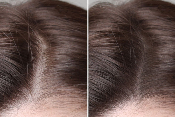 Is Hair Loss Reversible? What You Need to Know - TwoHerbs
