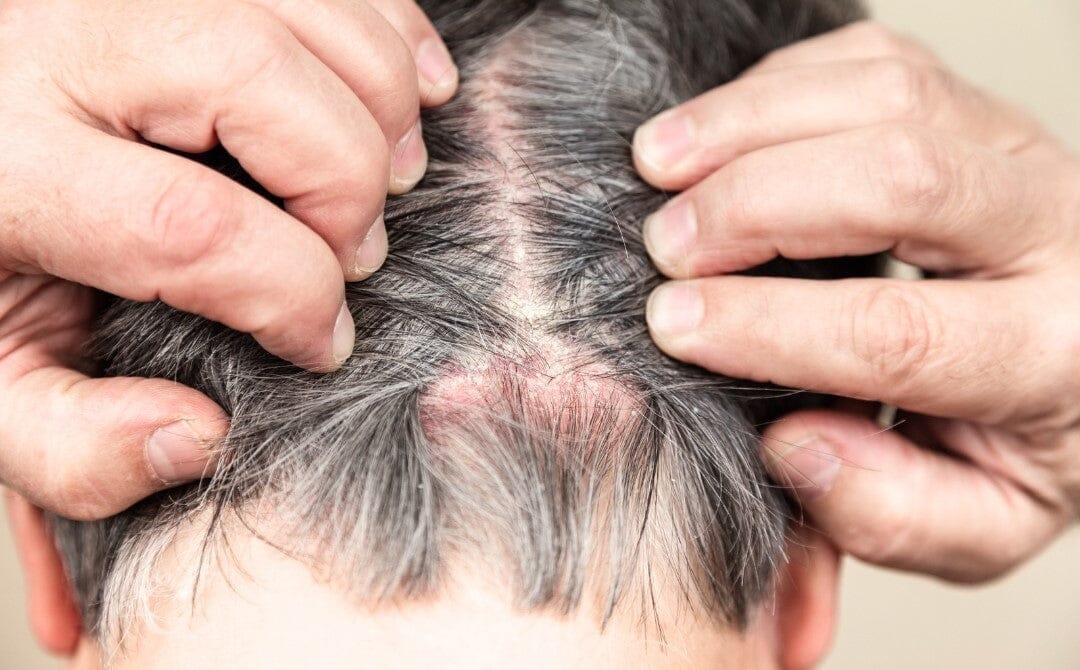 Itchy Scalp and Hair Loss: Why the Two Show Up Together (and Which One to Treat First) - TwoHerbs