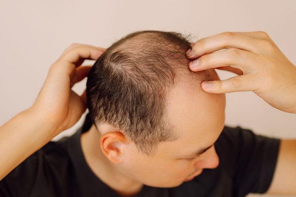 Male Hair Loss Treatment Singapore | Scalp-First Care for Men - TwoHerbs