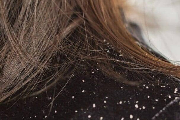 Managing Chronic Dandruff: Causes, Treatments, and Lifestyle Changes - TwoHerbs