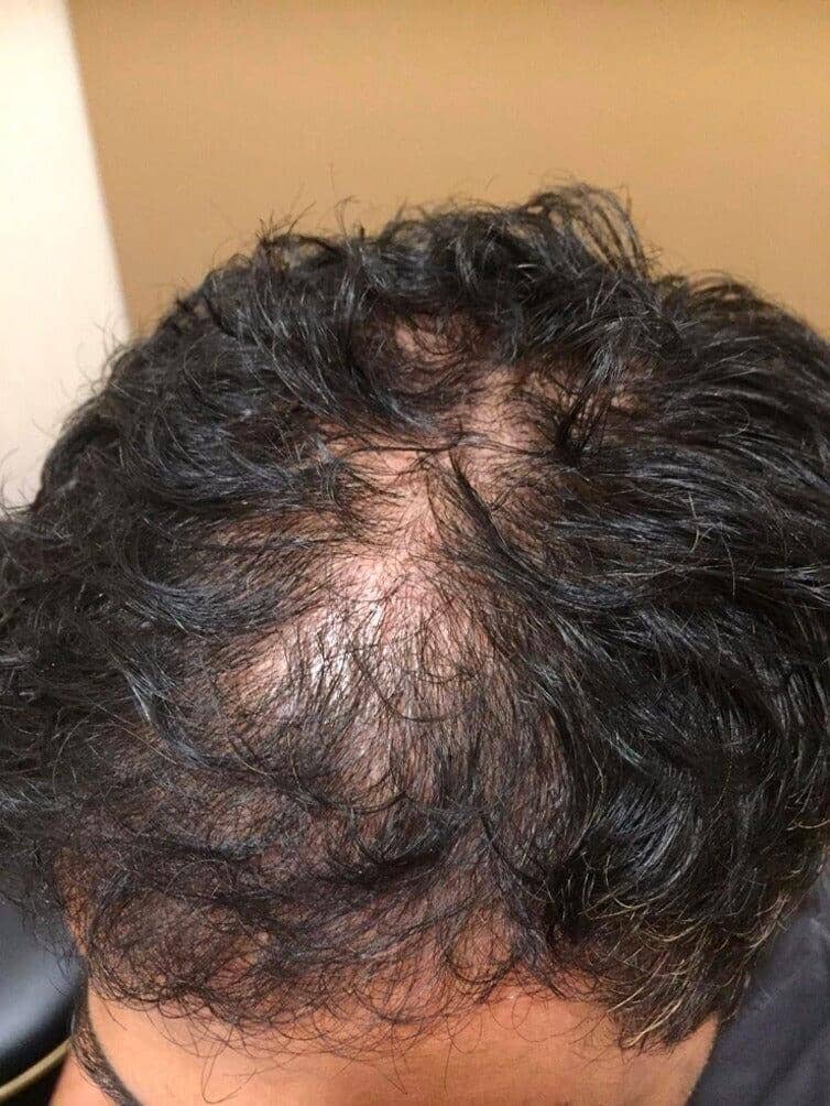 The Best Products for Male Hair Loss in Singapore: What Really Works According to Experts - TwoHerbs