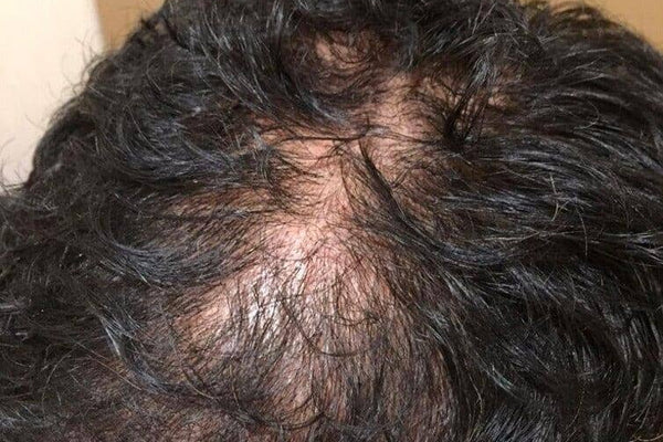 The Best Products for Male Hair Loss in Singapore: What Really Works According to Experts - TwoHerbs
