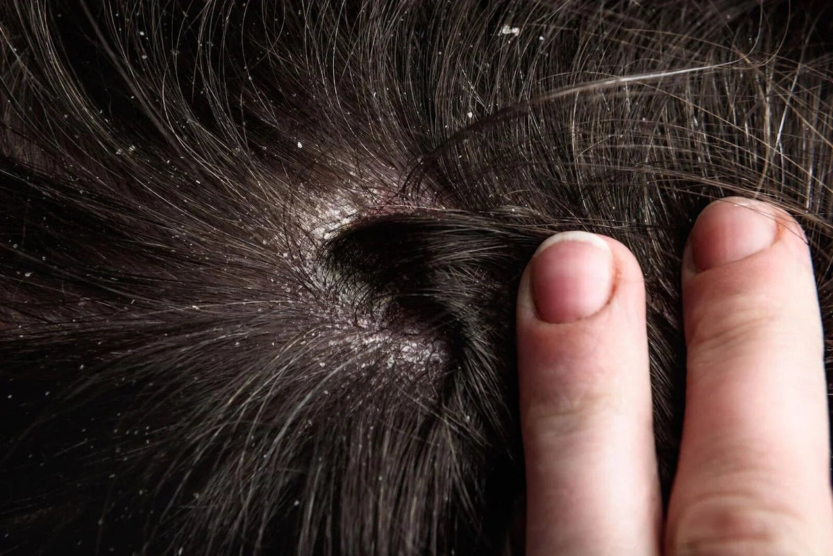 Best Dry Scalp Treatments in Singapore (2025 Dermatologist-Approved) - TwoHerbs