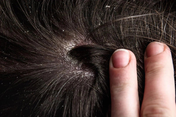 Best Dry Scalp Treatments in Singapore (2025 Dermatologist-Approved) - TwoHerbs
