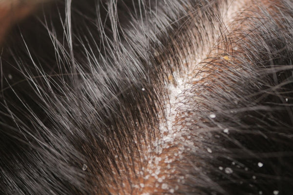 Best Hair Scalp Treatments in Singapore: 2026 Guide to Treat Scalp Problems + Best Solutions - TwoHerbs