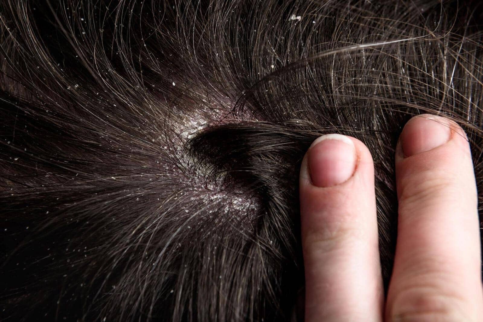 Can Dry Scalp Cause Hair Loss? Find Out Now! - TwoHerbs
