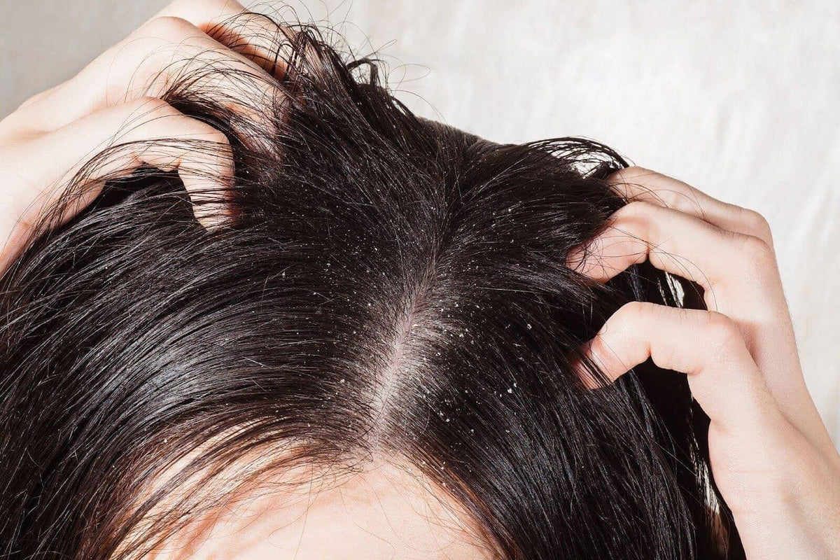 Dandruff Vs Dry Scalp: What's The Difference? - TwoHerbs