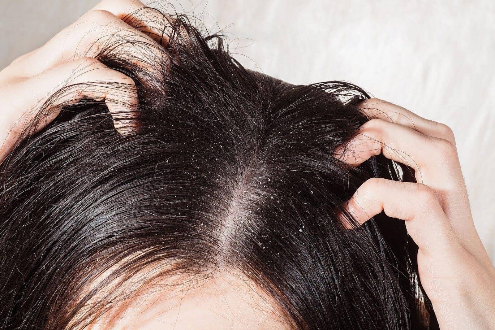 Dandruff Vs Dry Scalp: What's The Difference? - TwoHerbs