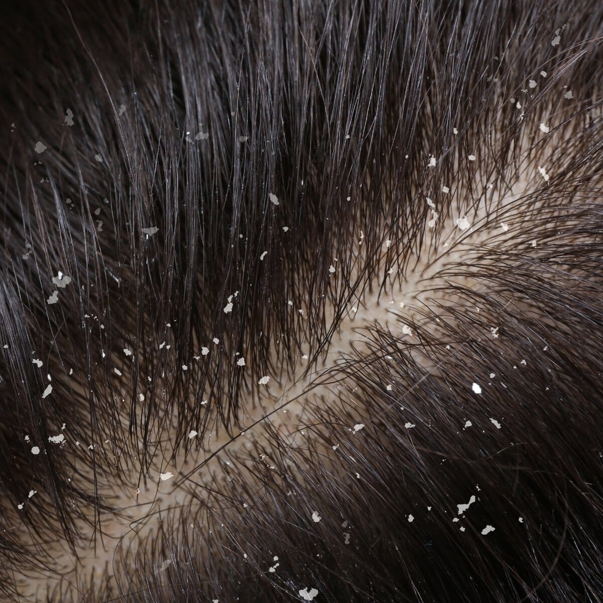 Does Dandruff Cause Hair Loss? Why Your Hair Falls Out With Flakes (And If It Grows Back) - TwoHerbs