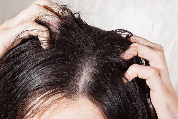 Dry Scalp Treatment Singapore | Causes, Best Solutions & Products - TwoHerbs