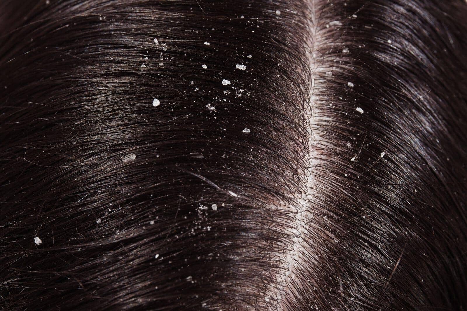 Dry Scalp Treatments in Singapore (2025): Causes, Remedies & Solutions - TwoHerbs