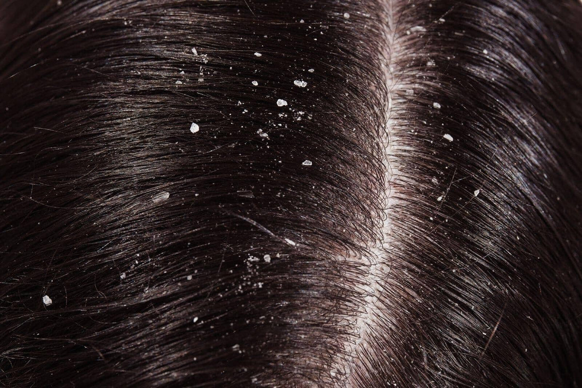 Dry Scalp Treatments in Singapore (2025): Causes, Remedies & Solutions - TwoHerbs