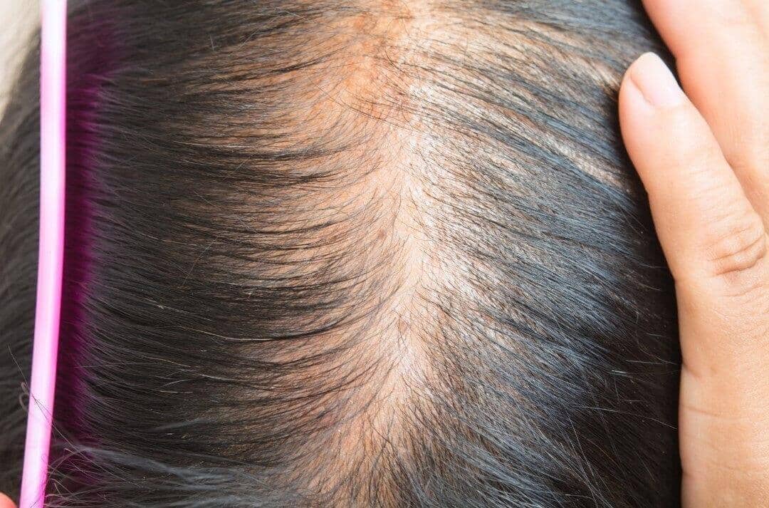 Early Signs of Hair Thinning - TwoHerbs