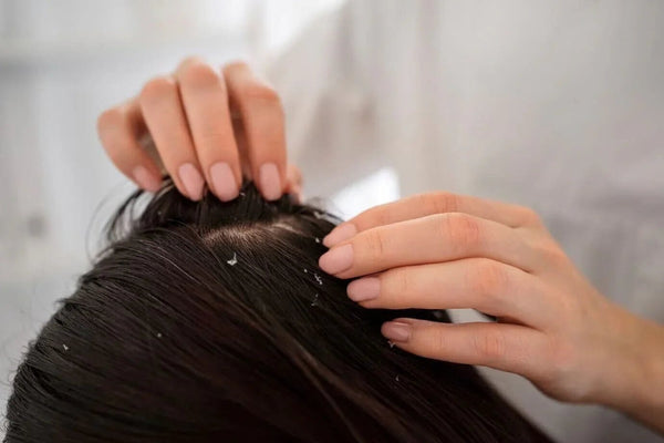 How To Get Rid Of Excess Sebum On Scalp: 6 Tips - TwoHerbs
