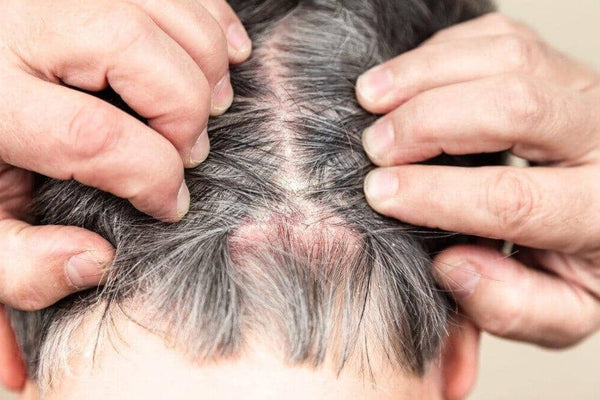 How to Treat and Manage Scalp Psoriasis - TwoHerbs
