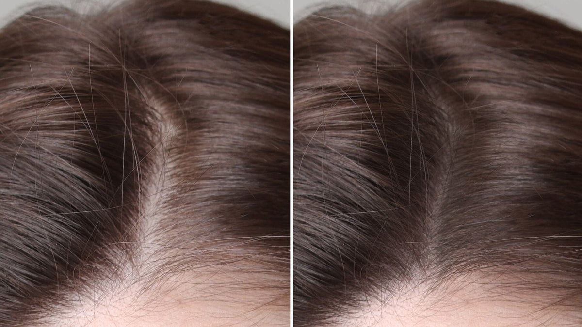 Is Hair Loss Reversible? What You Need to Know - TwoHerbs