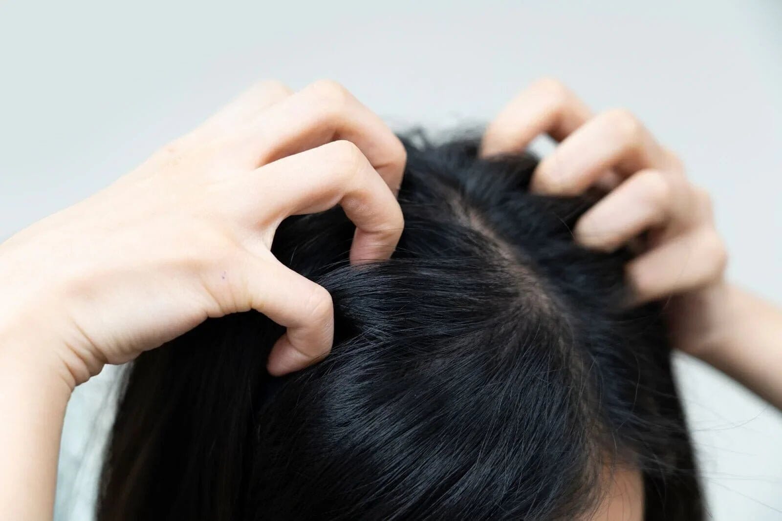 Itchy Scalp Treatment in Singapore (2025): Causes, Remedies & Solutions - TwoHerbs