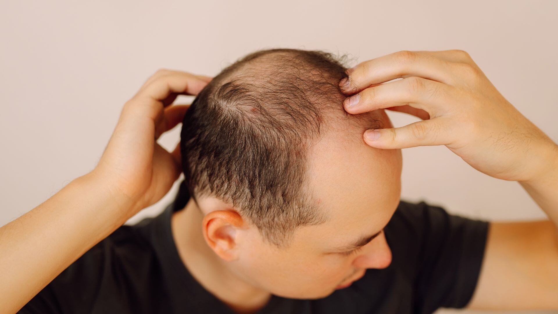 Male Hair Loss Treatment Singapore | Scalp-First Care for Men - TwoHerbs