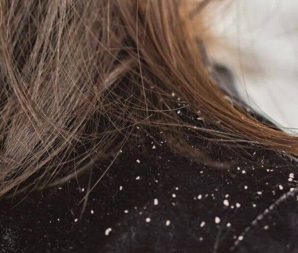Managing Chronic Dandruff: Causes, Treatments, and Lifestyle Changes - TwoHerbs