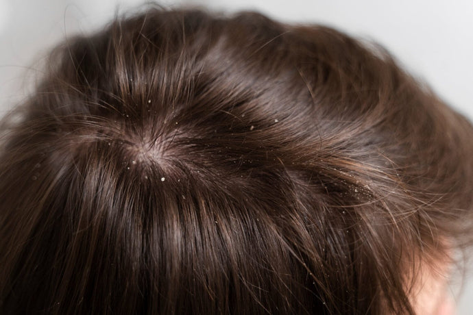 Scalp Build Up: 4 Things You Have To Know