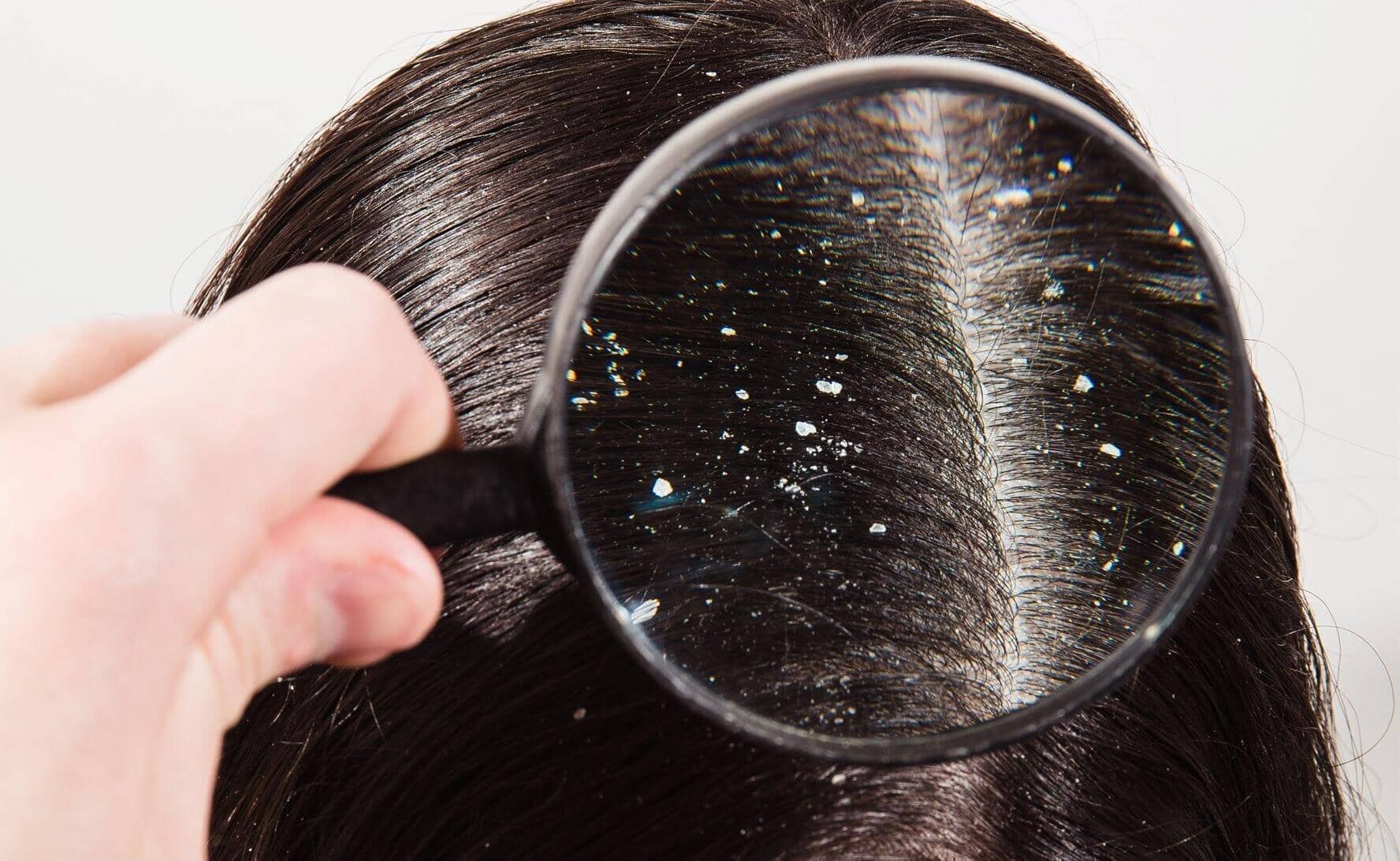 What Causes A Dry Scalp? 4 Things You Should Know - TwoHerbs