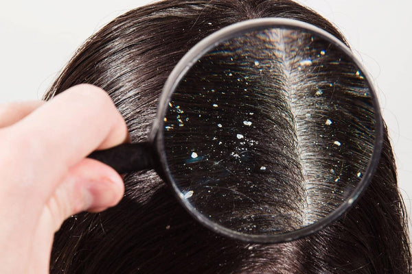 What Causes A Dry Scalp? 4 Things You Should Know - TwoHerbs