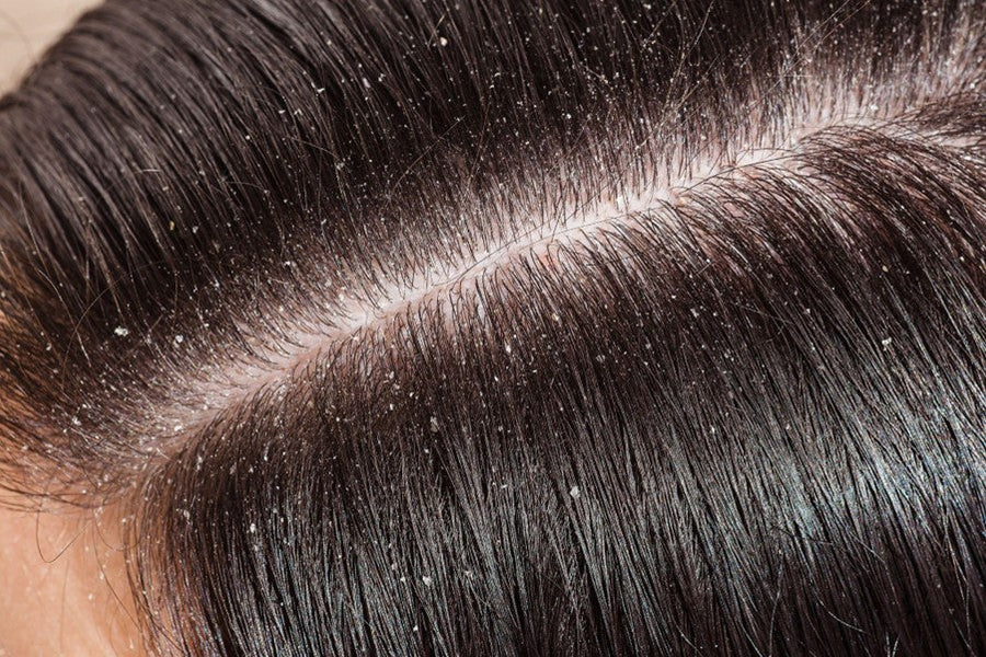 What Causes An Unhealthy Scalp?